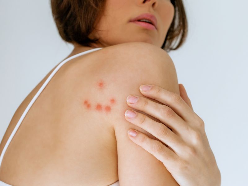 punaises de lit sans piqûres